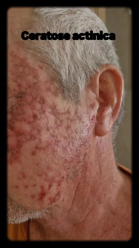 Capa do vídeo: pele do rosto com sinais de ceratose actínica