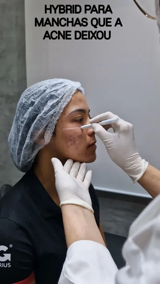 Capa do vídeo: aplicação de laser no rosto de uma paciente
